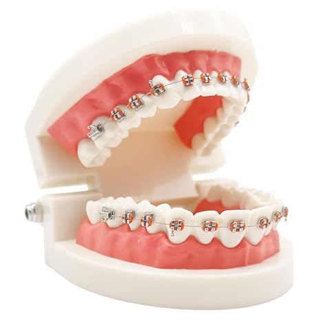 Easyinsmile Dental Orthodontic Teeth Model with Metal Bracket Tooth Model with Braces for Patients Communication