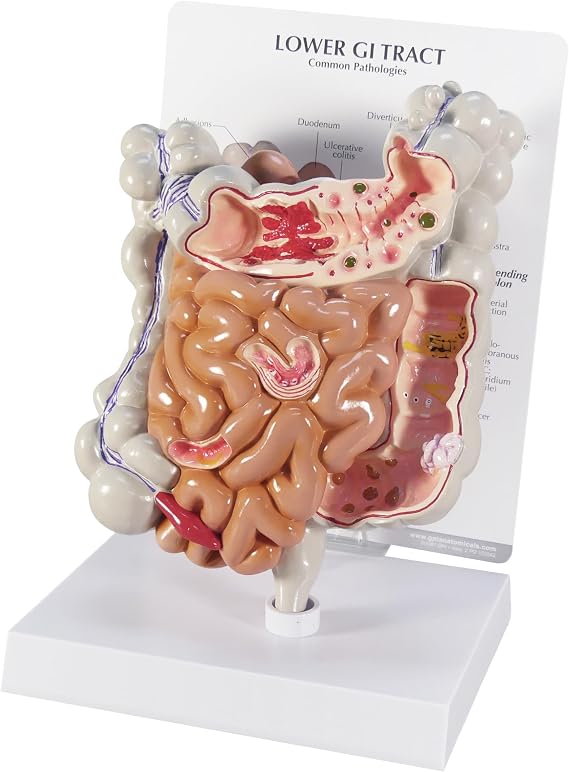 GPI Anatomicals Human Anatomy Model of GI Tract with Common Pathologies