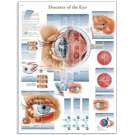 3B Scientific VR1231L Glossy Laminated Paper Diseases of The Eye Anatomical Chart, Poster Size 20" Width x 26" Height